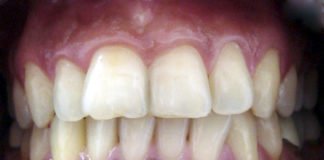 Racial pigmentation